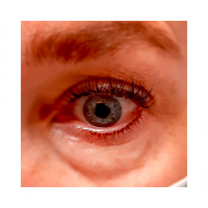 Wimpernkranzverdichtung Unterlid